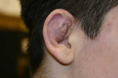 cauliflower ear wrestling